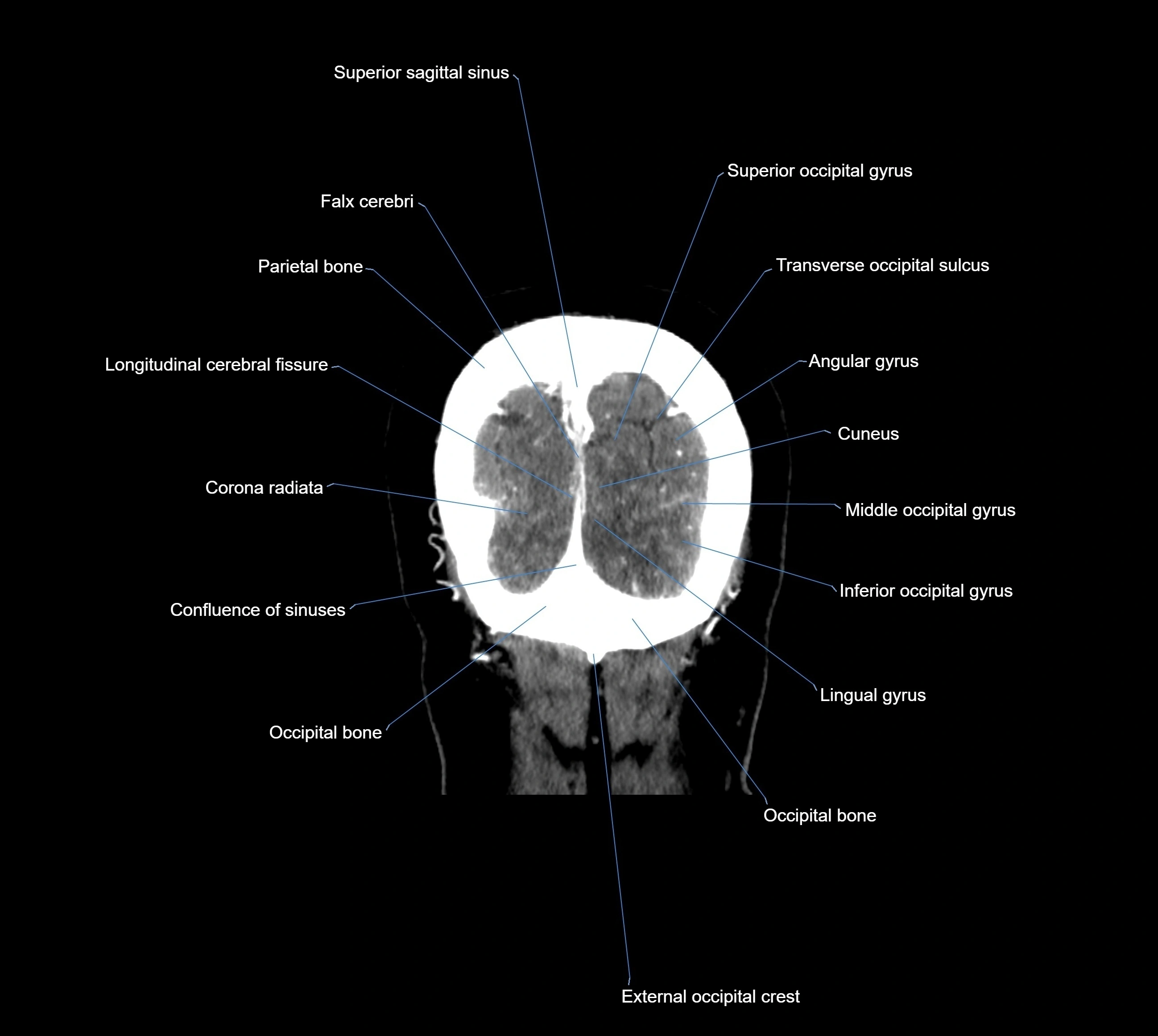 CT Brain coronal cross sectional radiology anatomy image  -img-00001-042.webp